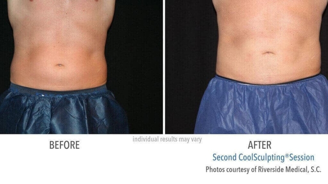 Coolsculpting: The Chilling Solution for Fat Freezing