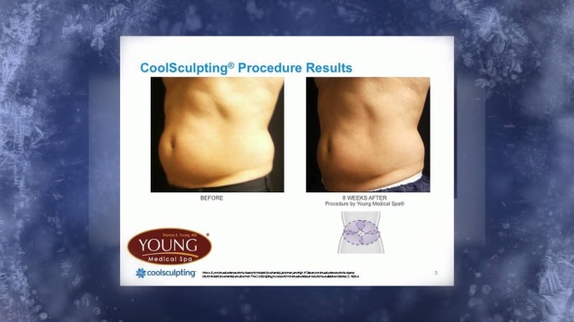 Frosty Beauty: Unveiling the Secrets of Cool Sculpting and Fat Freezing
