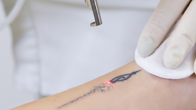 How Expensive Can Tattoo Removal Try To Be?