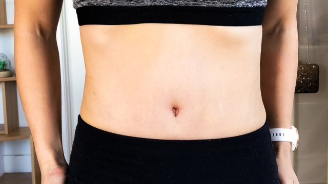 Belly Bliss: The Marvels of Abdominoplasty Revealed