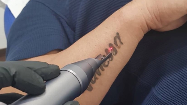 Tattoo Removal Methods – What Works And What Doesn’t