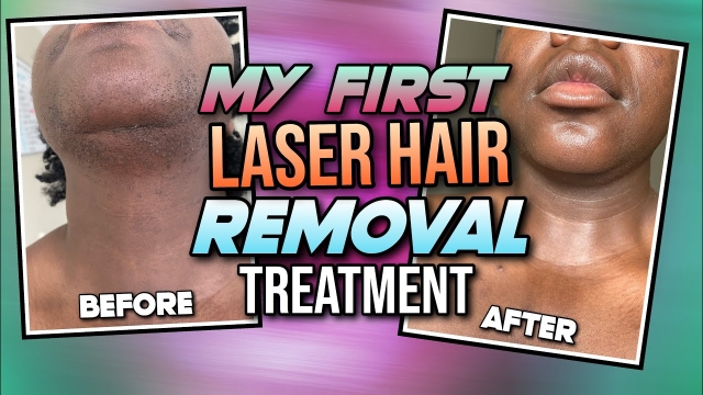 Say Goodbye to Unwanted Hair: The Laser Hair Removal Guide